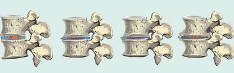 Spinal Läsion am Fall vun der thoracescher Osteochondrose