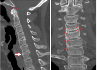 Den CT-Scan weist beschiedegt Wirbelen a Scheiwen vun heterogener Héicht wéinst der thoracescher Osteochondrose