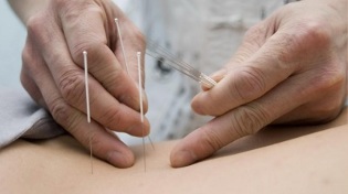 Akupunktur fir Lendeger Osteochondrose