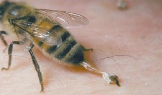Behandlung vun Hip Arthrosis duerch Bienen