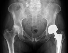 Diagnos vun Arthrosis vum Hip Gelenk