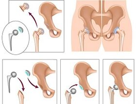 Endoprothetik fir Arthrosis vum Hip Gelenk