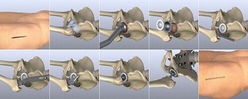 Methode vun der Behandlung vun Hip Arthrosis