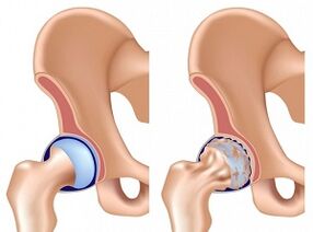 Symptomer vun Hip Arthrosis