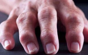 rheumatoider Arthritis als Ursaach vu Gelenkschmerzen